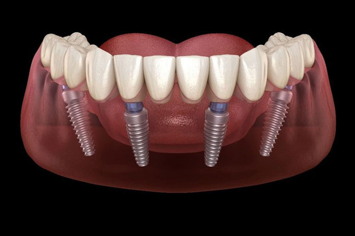 Full Mouth Rehabilitation with Implants