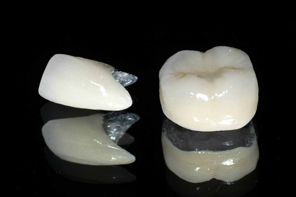 Tooth Coloured Ceramic Crowns