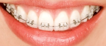 Ceramic or clear braces system