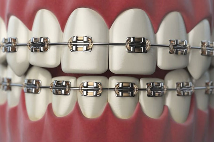 Dental Braces