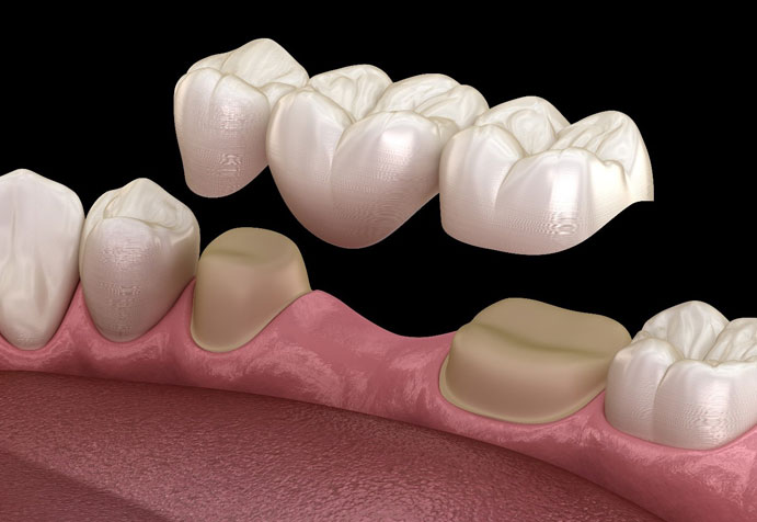 Dental Bridge