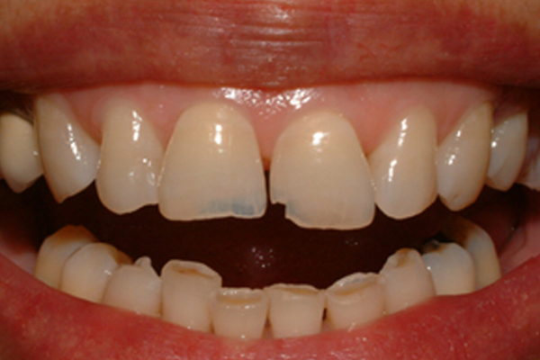 Cosmetic Dentistry Before