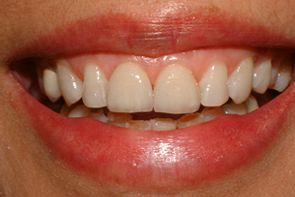 Cosmetic Dentistry After