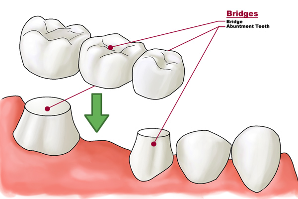 Tooth Coloured Ceramic Crowns