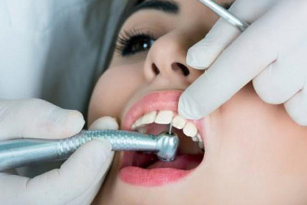  Ceramic Crowns