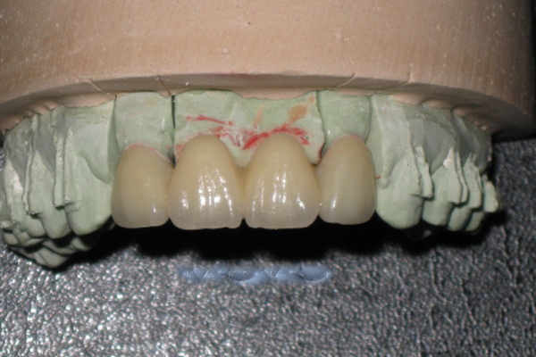 Tooth Coloured Ceramic Crowns