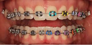 Dental Braces